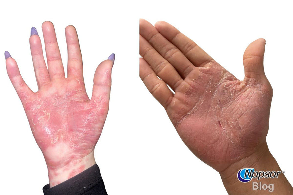 Palmoplantar Pustulosis vs. Palmoplantar Psoriasis